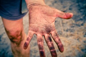 花粉症による肌バリアの低下と敏感肌の洗いすぎ、見分け方は？